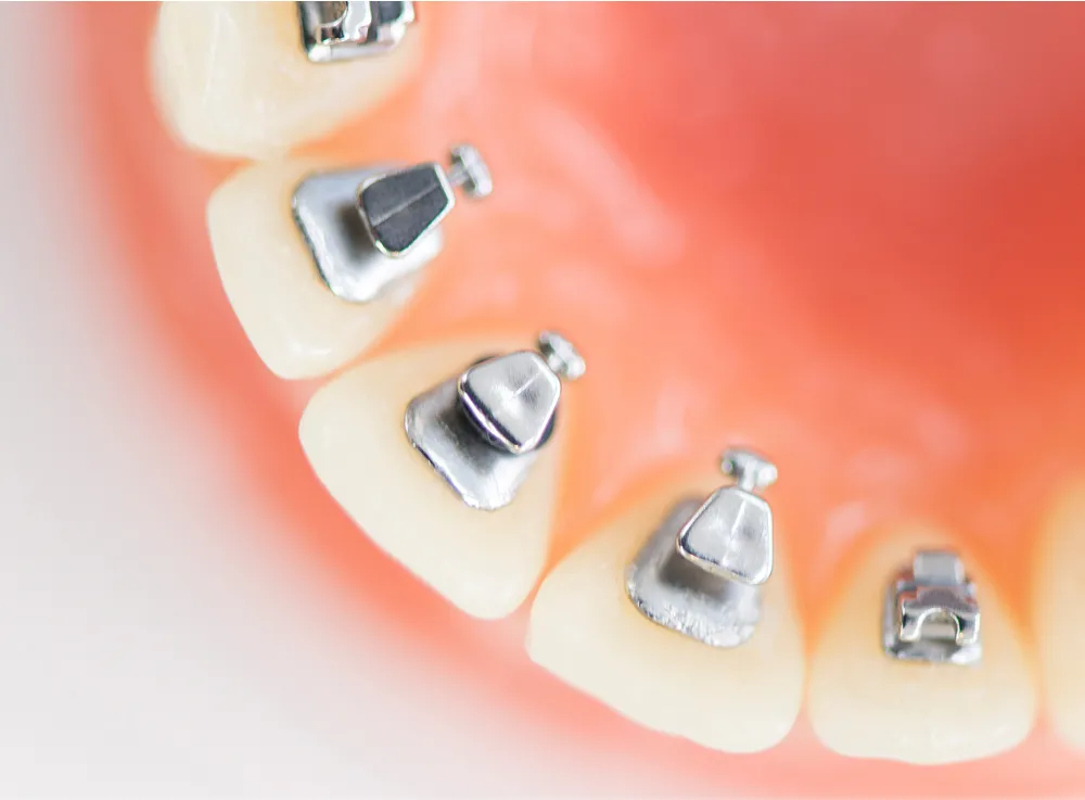 リンガルブラケット矯正